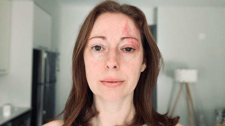 A woman with red hair and a birthmark covering her left eye and the left side of her forehead.