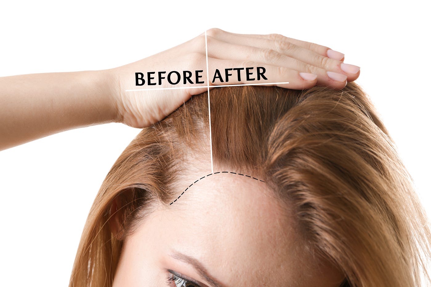 Regrowing Hair Using Red Light Therapy | by John Iovine | Medium