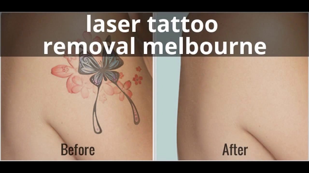 Benefits Of Availing Laser Treatment From Tattoo Removal Clinic Melbourne By City Of Ink Medium