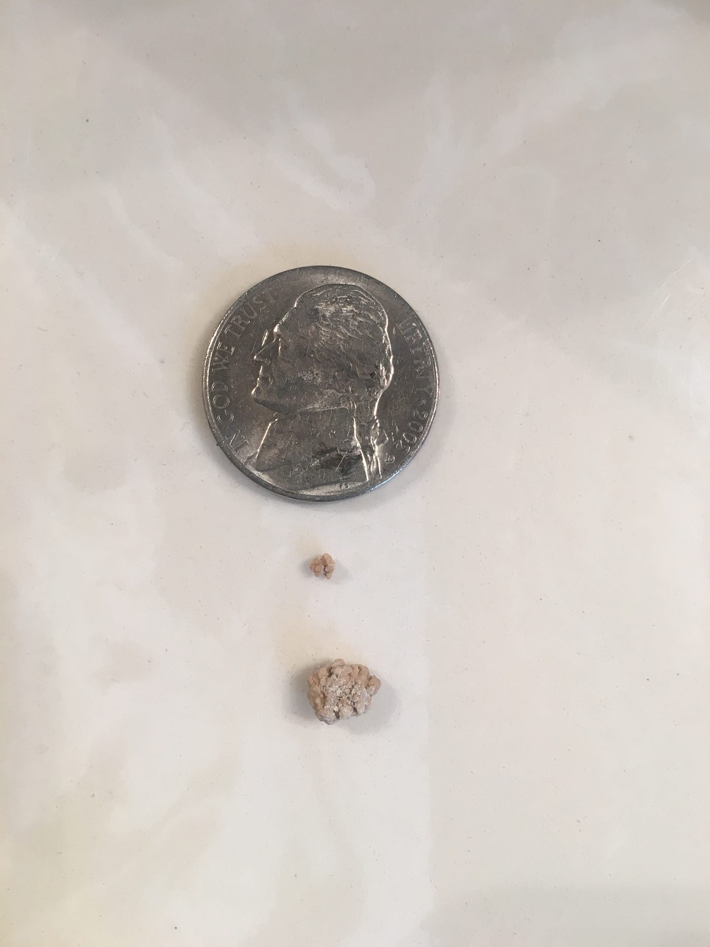 I Ve Passed Over 200 Kidney Stones By Ree Jackson Medium