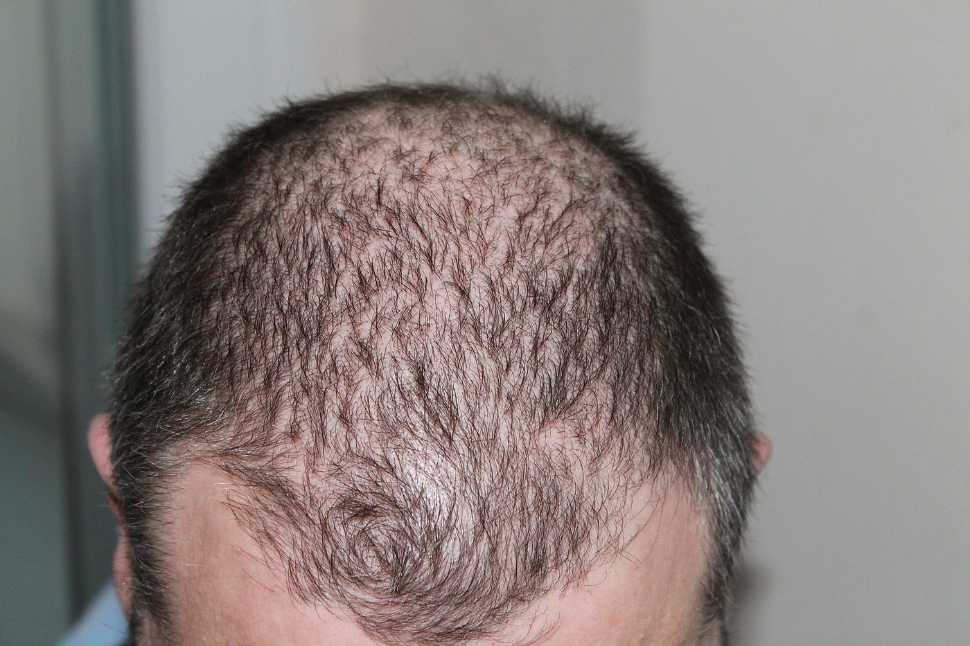 How to Handle a Bad Hair Surgery. When ointments, toupees, wigs, and… | by  Dr. U Hair and Skin | Medium