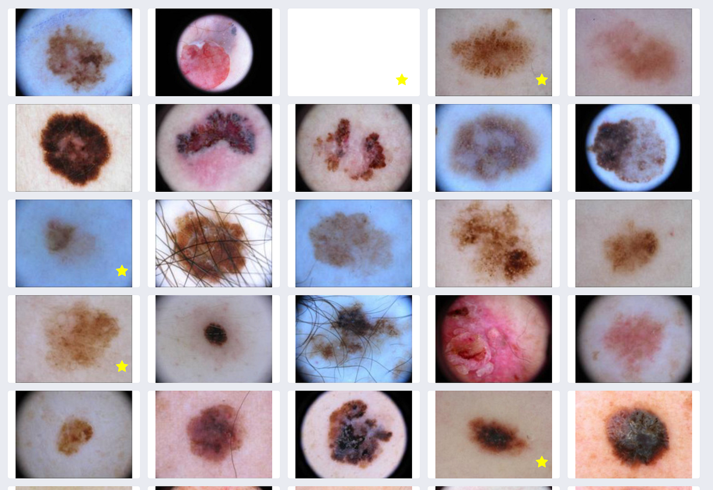 melanoma-mole
