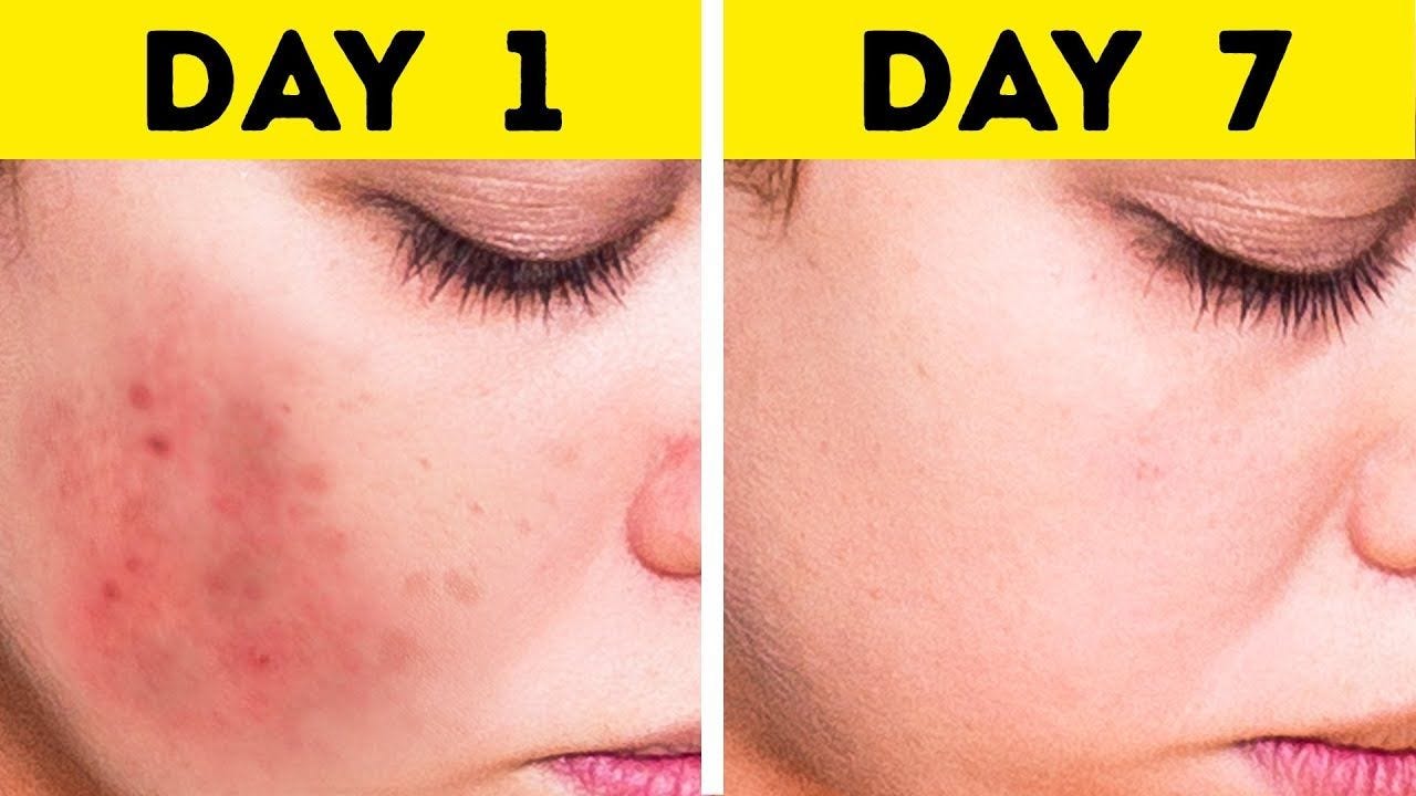 5 Best Ways To Remove Dark Spots From Your Skin By Asad Omer Medium