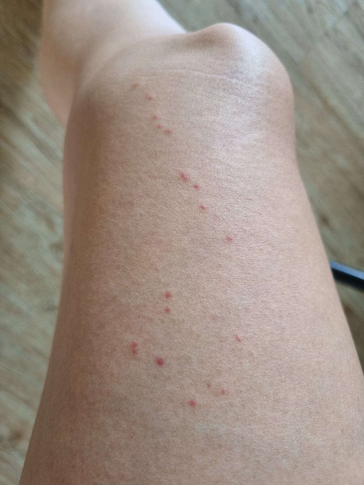 flea bites on ankles