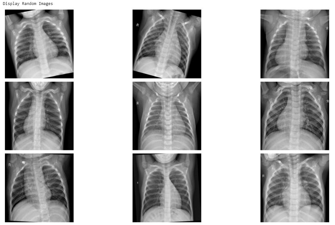 Deep Learning in Healthcare — XRay Imaging (Part 4The Class Imbalance