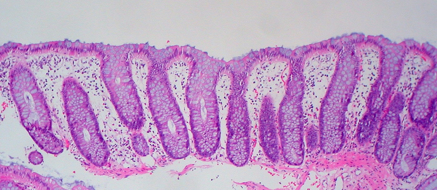 Understanding IBD: Crohn’s Disease and C. diff | by Caroline Stewart ...