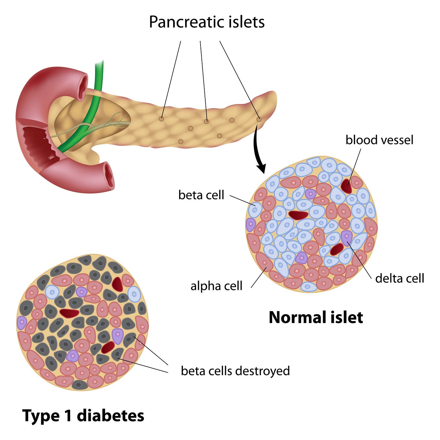 Acatalasemia and type 2 diabetes mellitus in: Orvosi Hetilap Volume Issue 10 ()