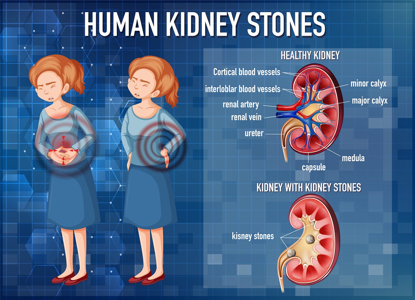 The Locations Of Kidney Stones