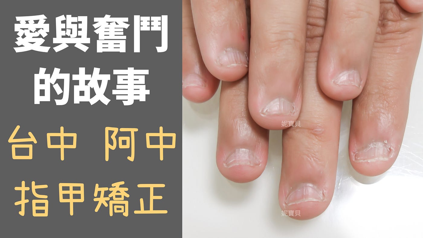 妮寶貝指甲 問題指甲矯正 Medium