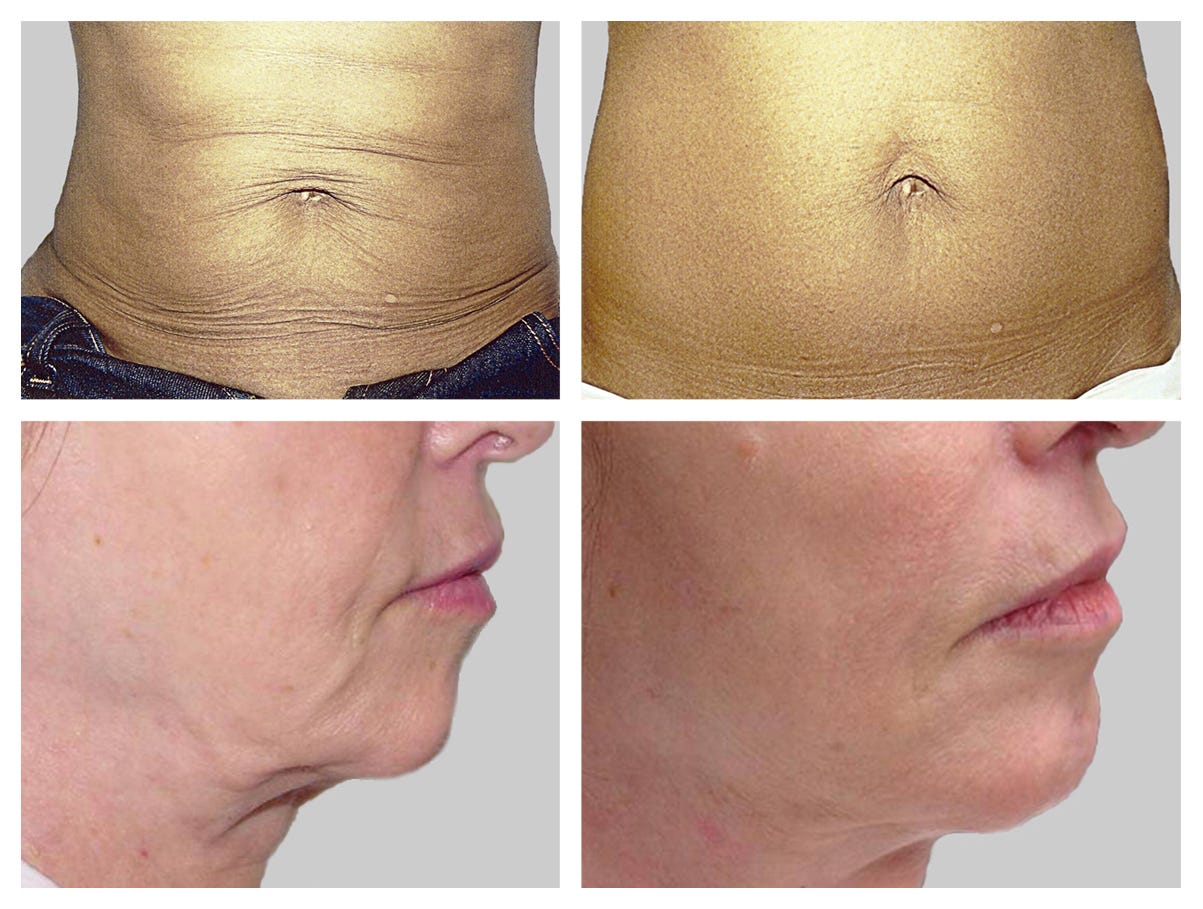 Whats the Skin tightening buzz about? What is the science behind it and why should one get it
