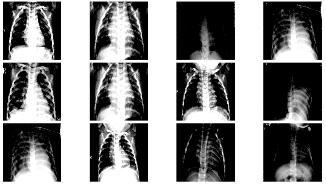 Deep Learning in Healthcare — XRay Imaging (Part 5Data Augmentation