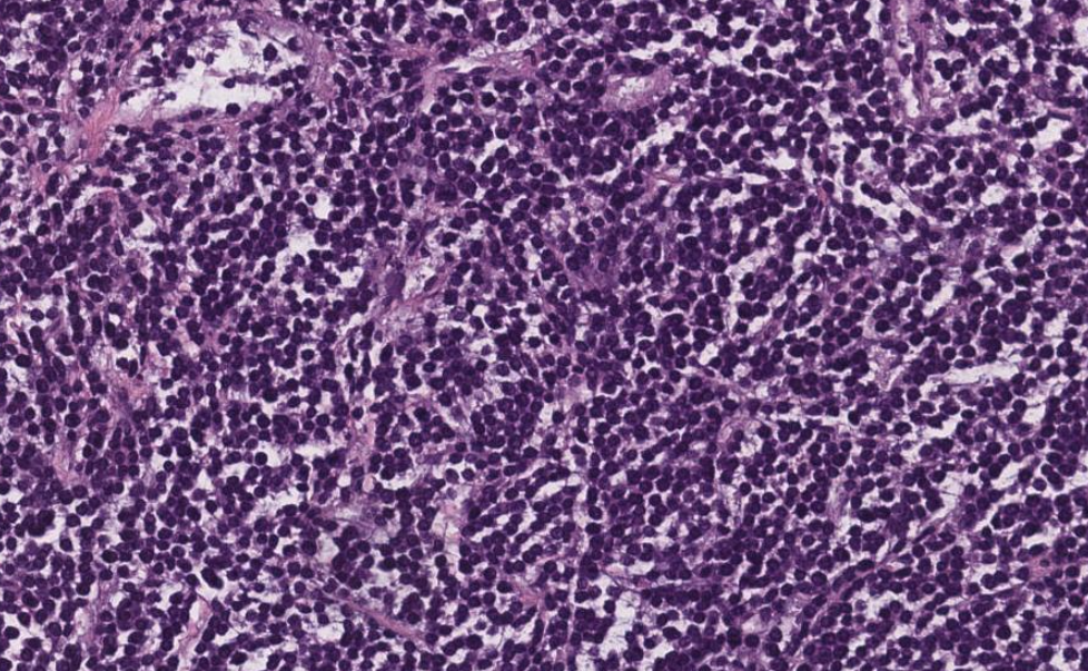 High Grade BCell Lymphoma, Triple Hit with BurkittLike Features by