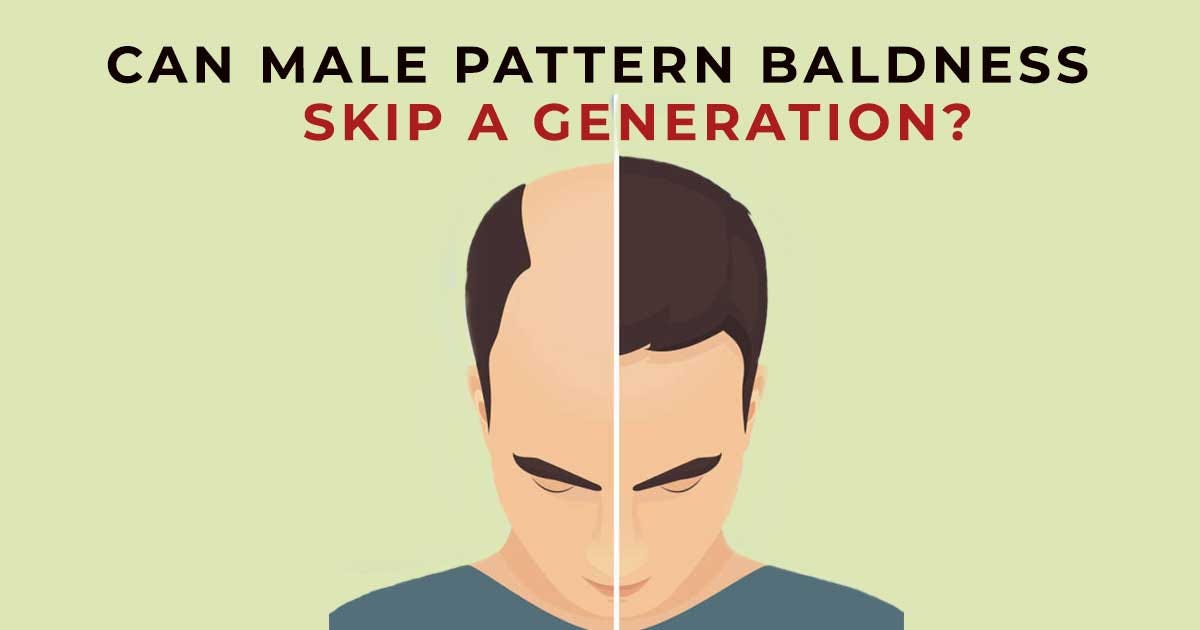 Does Baldness Continually Flow Throughout The Generations By Satyam Hair Transplant Medium Does Baldness Continually Flow Throughout The Generations By Satyam Hair Transplant Medium