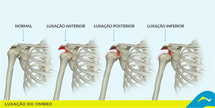 Luxação no ombro? Só 5km :) talvez dê | by Joao A F Andrade - UTLC | Medium