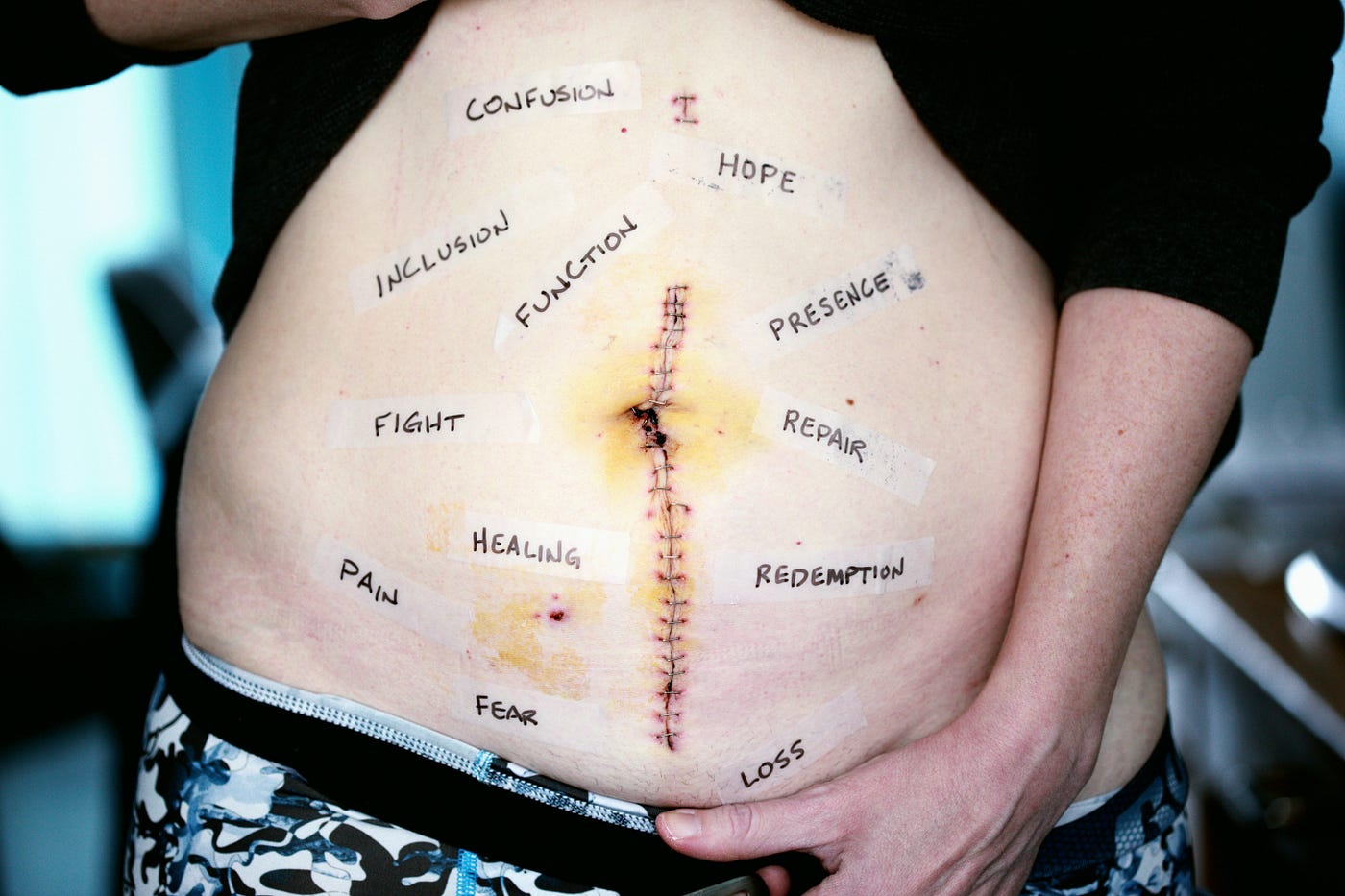 Patient With Abdominal Stitches Tatooed With Expectations