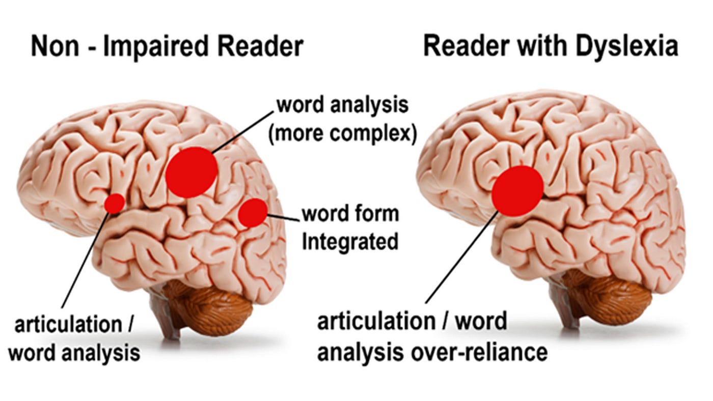 The left brain — comparing dyslexic and non-dyslexic brains.