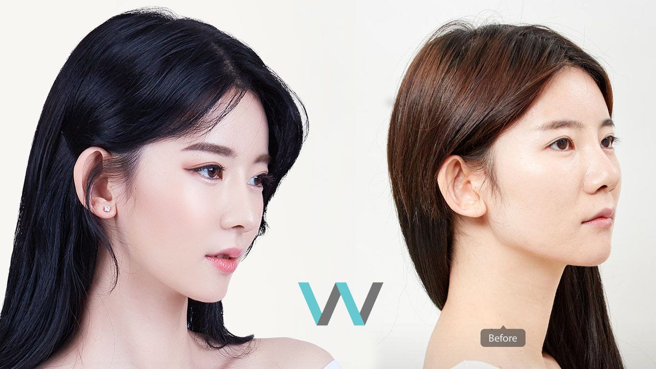 Quick Tips for Successful Korean Rhinoplasty by Valerie Park Medium