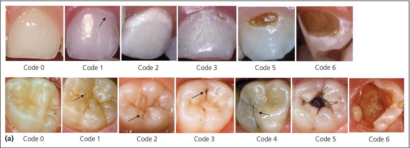 A.I. Based Cavity Detection System | by Murli Jadhav | Medium