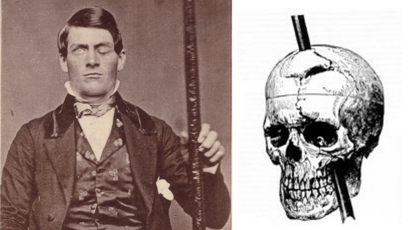 phineas gage case study quizlet