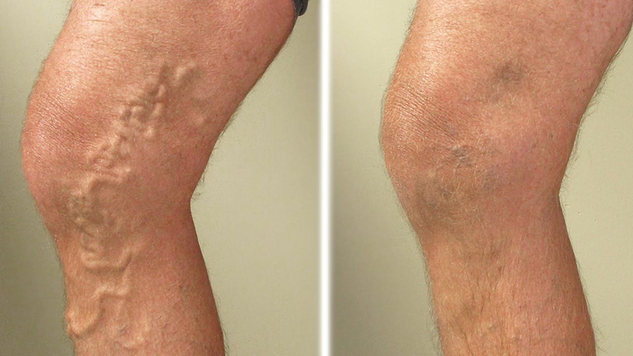 All About Varicose Veins During Pregnancy - Parents