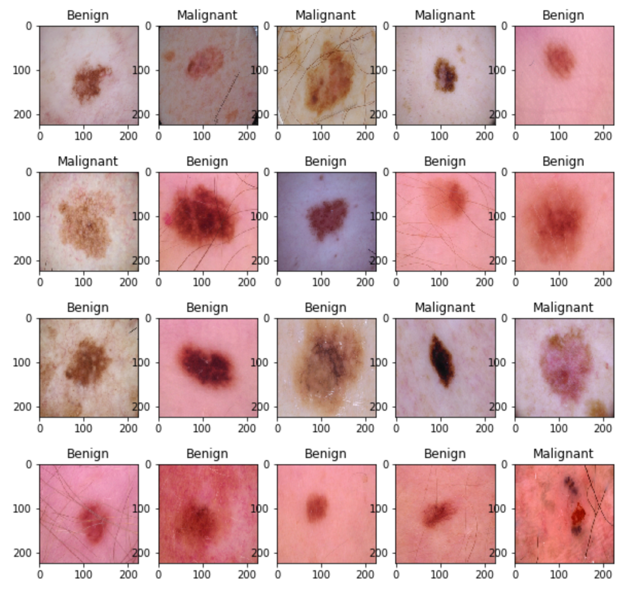 Skin cancer benign mole