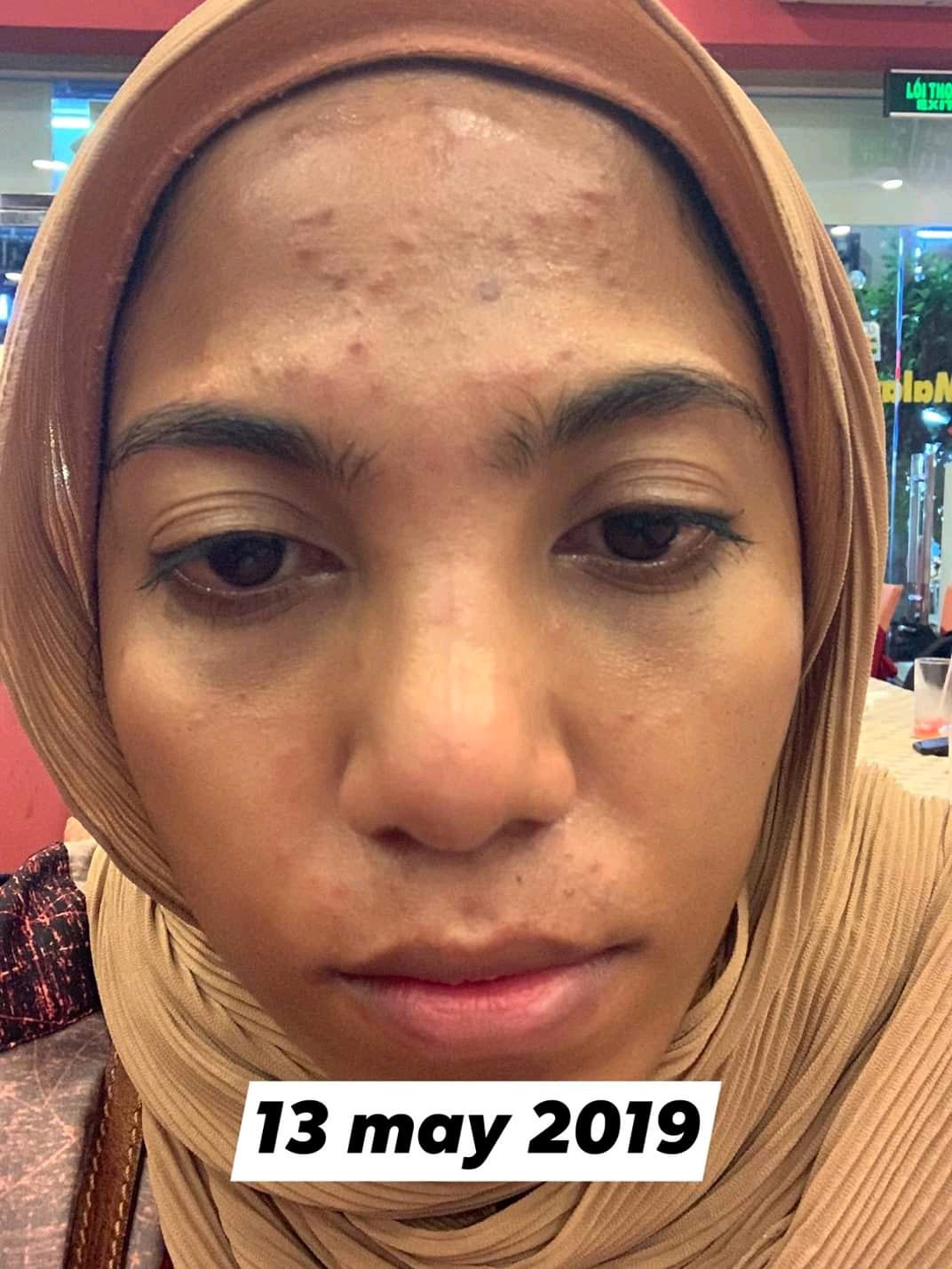 Cara Menghilangkan Jerawat Pasir Di Wajah Pipi Dagu Secara Alami Dijamin Ampuh By Ndres Pratam Medium
