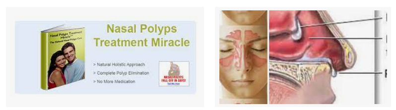 Nasal Polyps Treatment Miracle Reviews | Does It Work?
