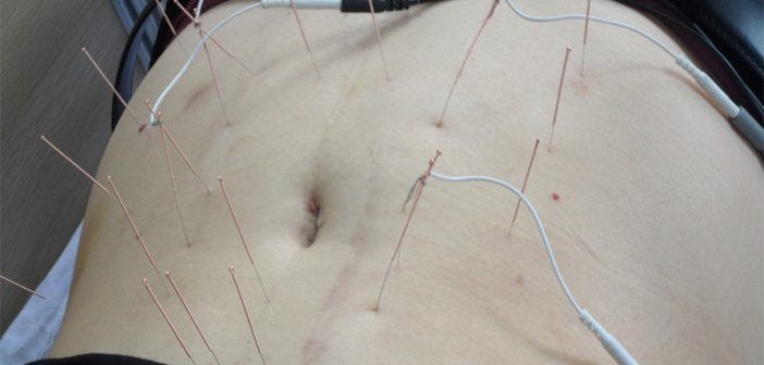 acupuncture for weight loss