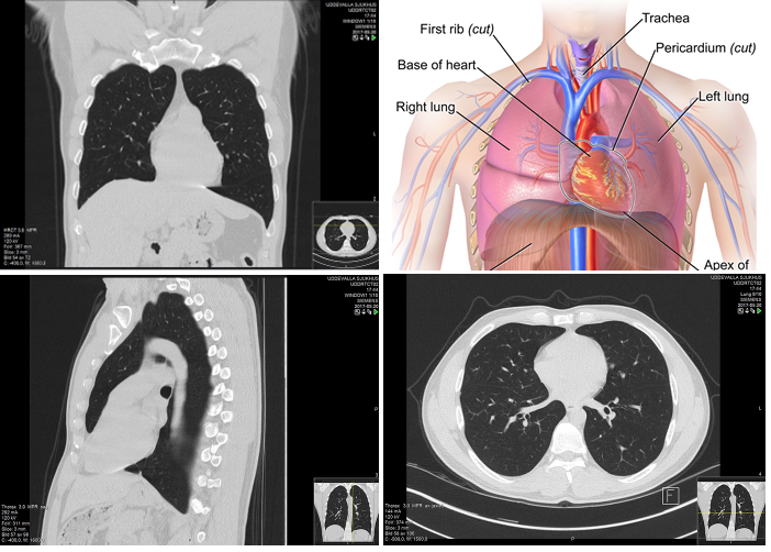 Automatic Interpretation of Chest CT Scans with Machine Learning by