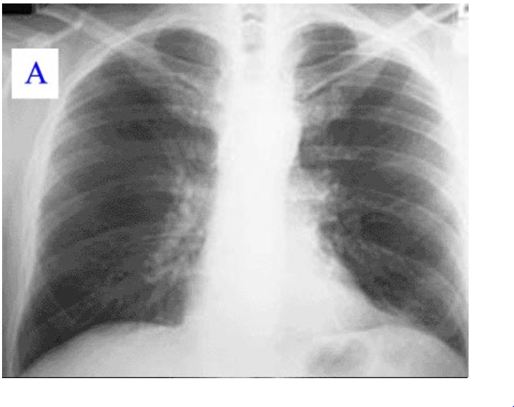Pneumonia Chest X Ray Diagnosis