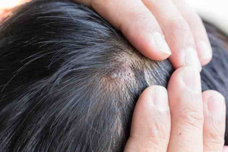 Psoriasis And Hair Health Melissa Senol Medium
