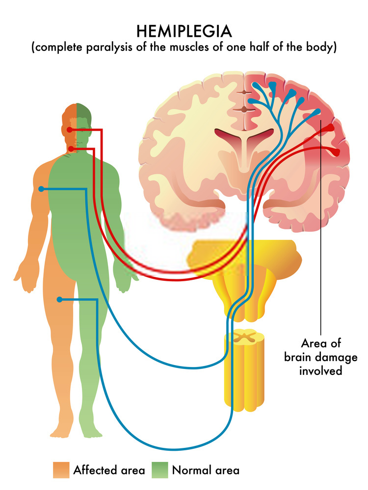 Hemiparesis causes and treatment by sakshi adi Health Care News