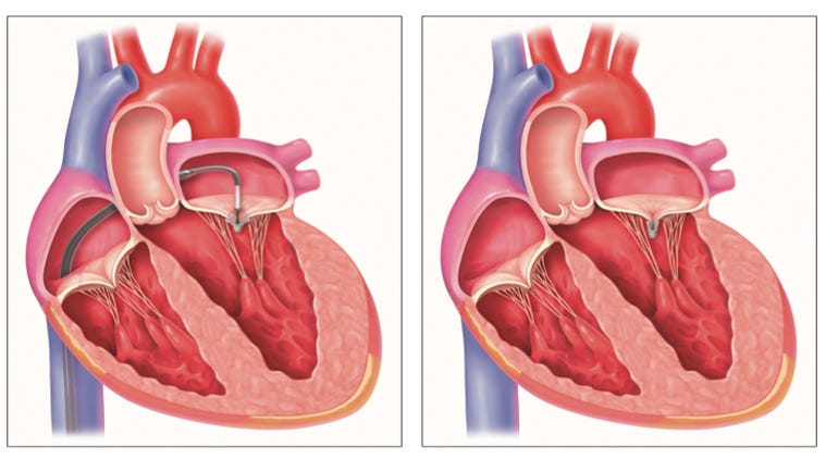 Mitral Valve Replacement The Mitral Valve Is Located Between The By