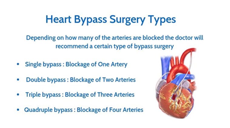 Coronary Artery Bypass Graft Surgery Cabg By Magnus Medi Medium