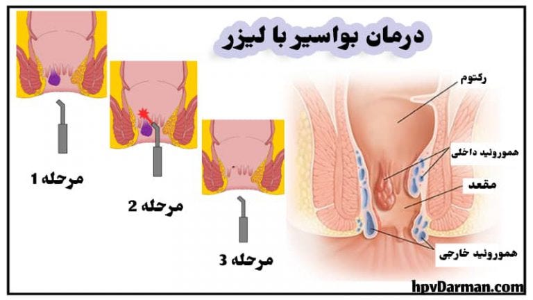 درمان بواسیر(هموروئید) با لیزر بدون عمل جراحی