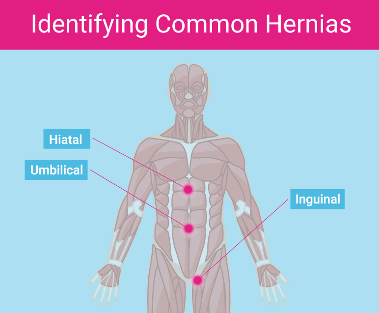 5 Signs You Have Hernia Mesh Complications By Medtruth Medium 