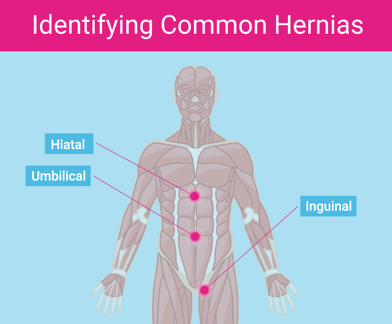 5 Signs You Have Hernia Mesh Complications by MedTruth Medium