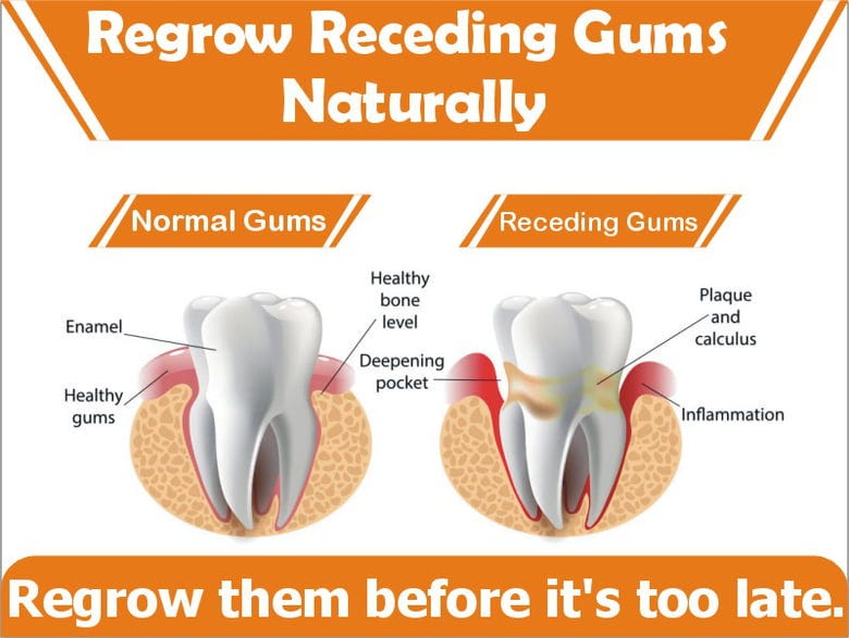 Natural Ways To Reverse Receding Gums | by Lori Baldwin | Medium