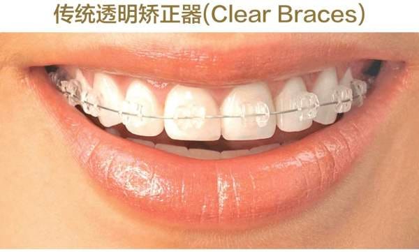关于牙齿矫正值得知道的一切 记得我念初中乃至高中的时候 周围也有好多钢牙君 当时看他们吃完饭后拿着小镜子对着 By 女神进化论丨hibetterme Medium 关于牙齿矫正值得知道的一切 记得我念初中乃至高中的时候 周围也有好多钢牙君 当时看他们吃完饭后拿着小镜子对着 By 女神进化论丨hibetterme Medium