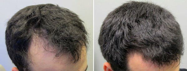 Minoxidil Combating Hair Loss In Men Jasminescottes Medium