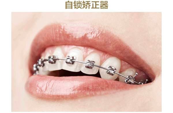 关于牙齿矫正值得知道的一切 记得我念初中乃至高中的时候 周围也有好多钢牙君 当时看他们吃完饭后拿着小镜子对着 By 女神进化论丨hibetterme Medium 关于牙齿矫正值得知道的一切 记得我念初中乃至高中的时候 周围也有好多钢牙君 当时看他们吃完饭后拿着小镜子对着 By 女神进化论丨hibetterme Medium