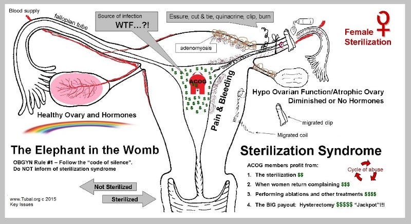 Essure Lawsuit Brooklyn Ny Zucker Regev P C Lawyer