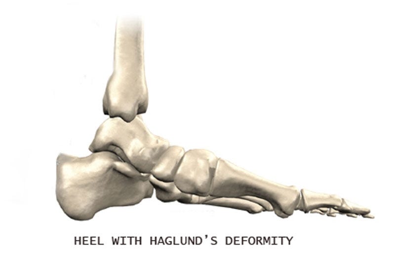 Haglund S Deformity Retrocalcaneal Pain Haglund S By Activefootcarepodiatry Medium