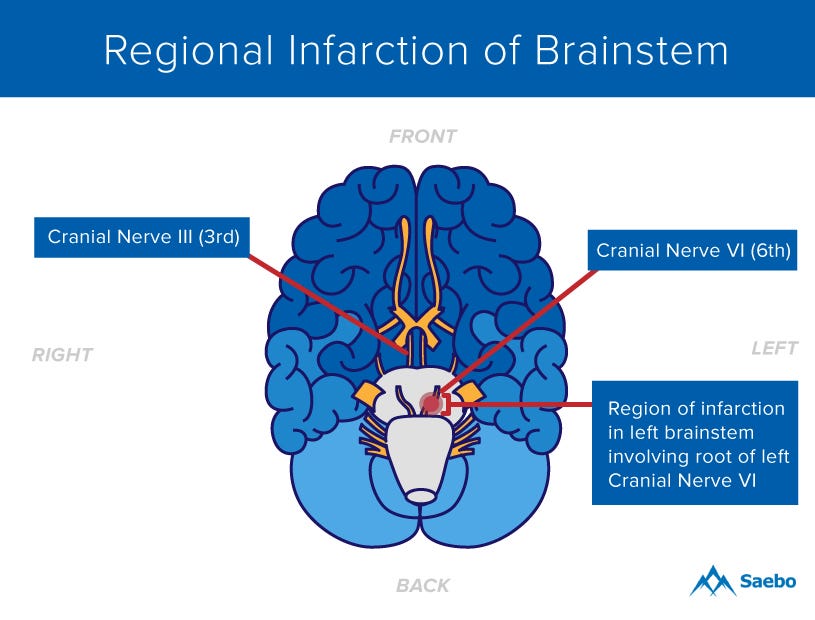 What Is A Brainstem Stroke   A Brainstem Stroke Can Cause