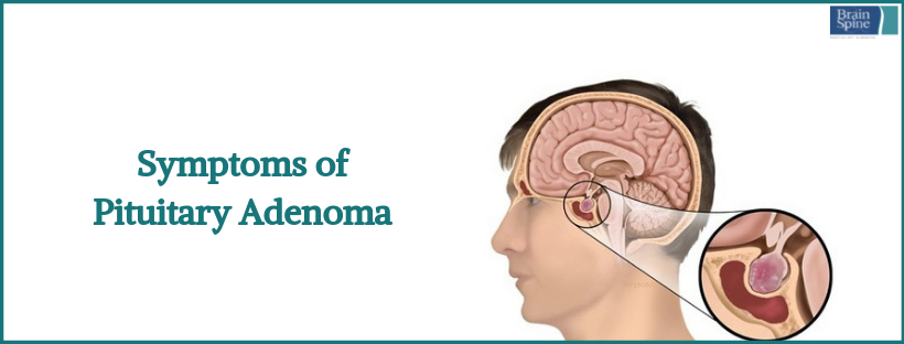 pituitary-adenomas-symptoms-treatment-and-surgery-pituitary-adenoma