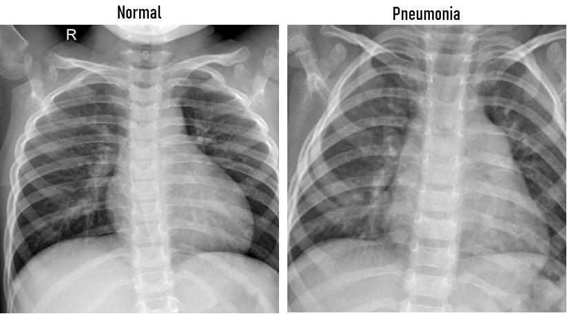 Chest X Rays Pneumonia Detection Using Convolutional Neural Network By Christie Natashia Archie Towards Data Science