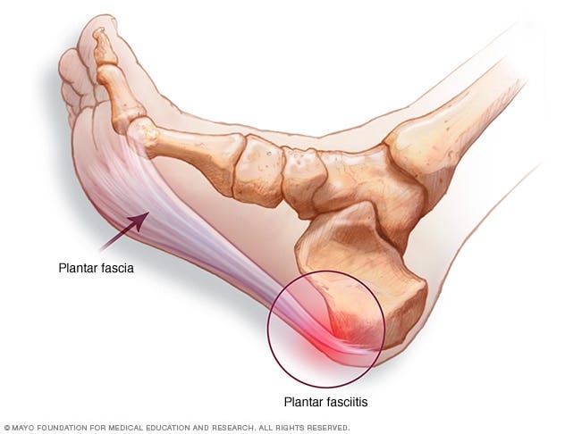 barefoot running plantar fasciitis