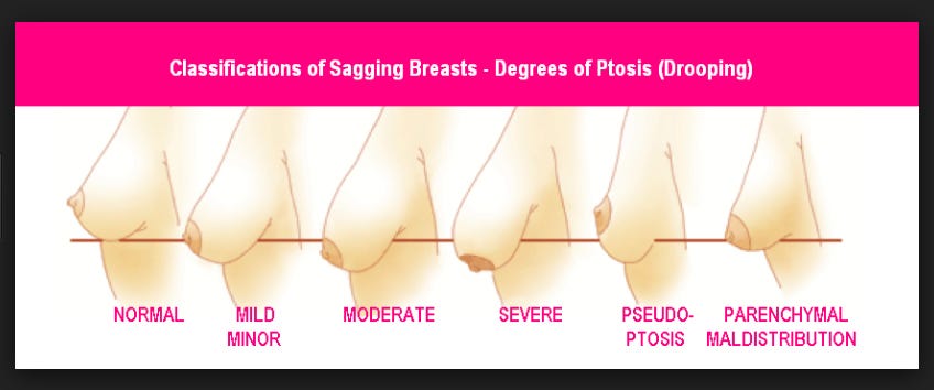 Breast Sagging — Things that every women must know - Maccablo - Medium