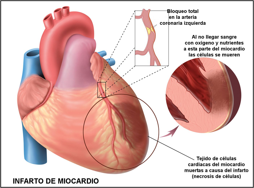Se Recupera El Musculo Del Corazon Despues De Un Infarto
