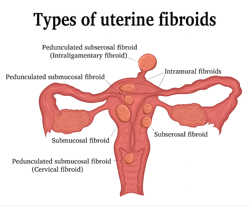 How to Fix Fibroids and Get Back to Work Fast | by Dr Jeff Livingston | BeingWell | Medium How to Fix Fibroids and Get Back to Work Fast | by Dr Jeff Livingston | BeingWell | Medium